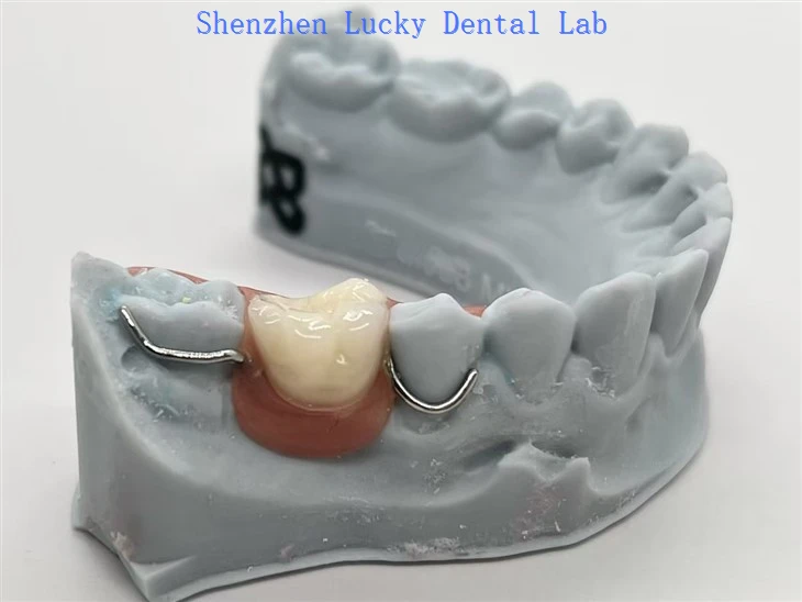 Inilateral Acrylic Denture